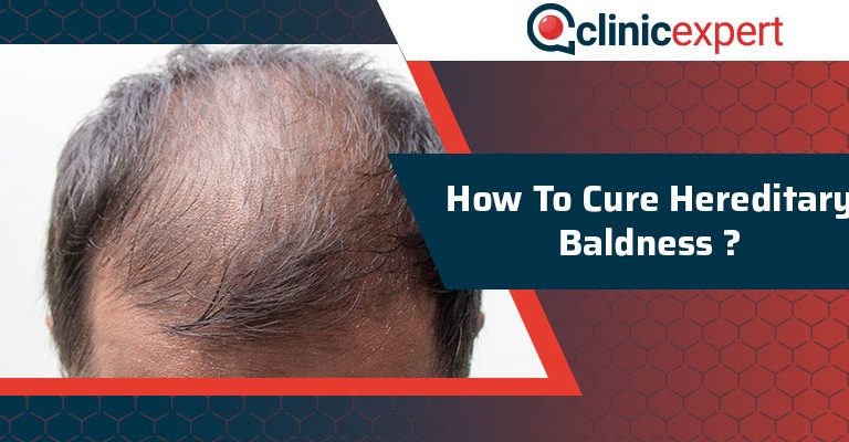 How To Cure Hereditary Baldness?