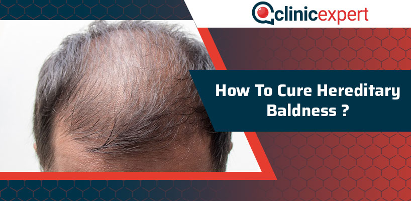 How To Cure Hereditary Baldness?