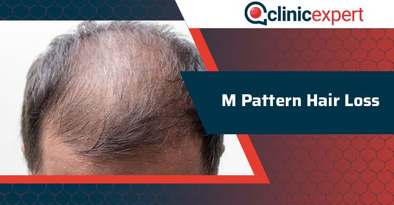 M Pattern Hair Loss
