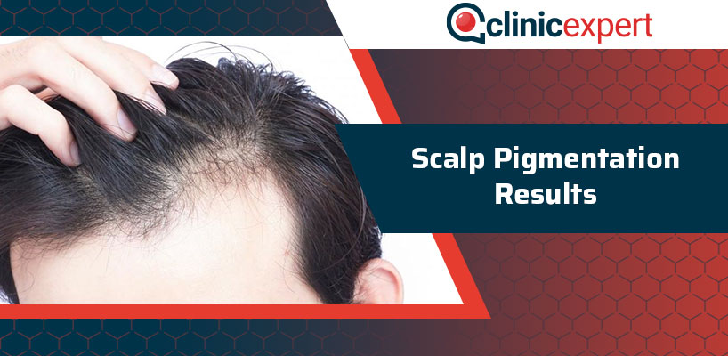 Scalp Pigmentation Results