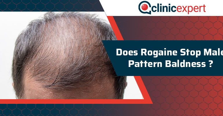 Does Rogaine Stop Male Pattern Baldness?