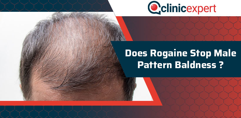 Does Rogaine Stop Male Pattern Baldness? | ClinicExpert