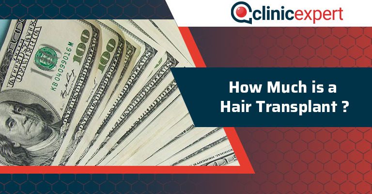 How Much Is A Hair Transplant?