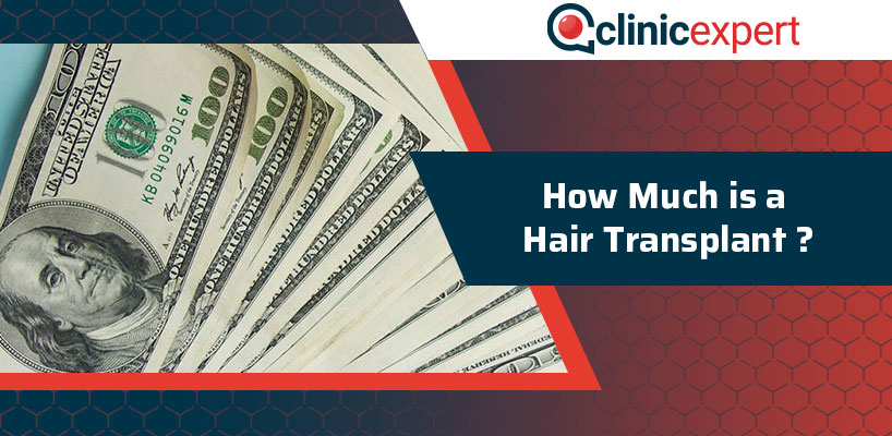 How Much Is A Hair Transplant?