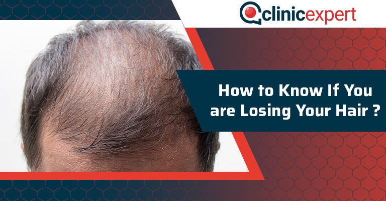 How to Know If You are Losing Your Hair?