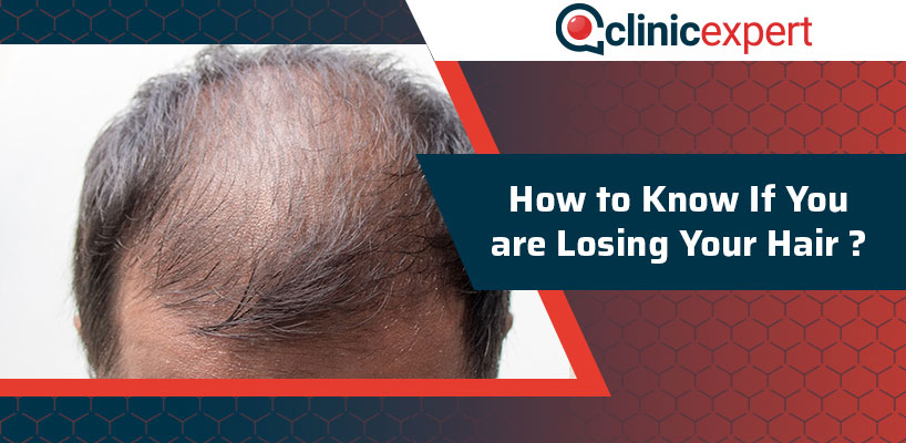How to Know If You are Losing Your Hair?