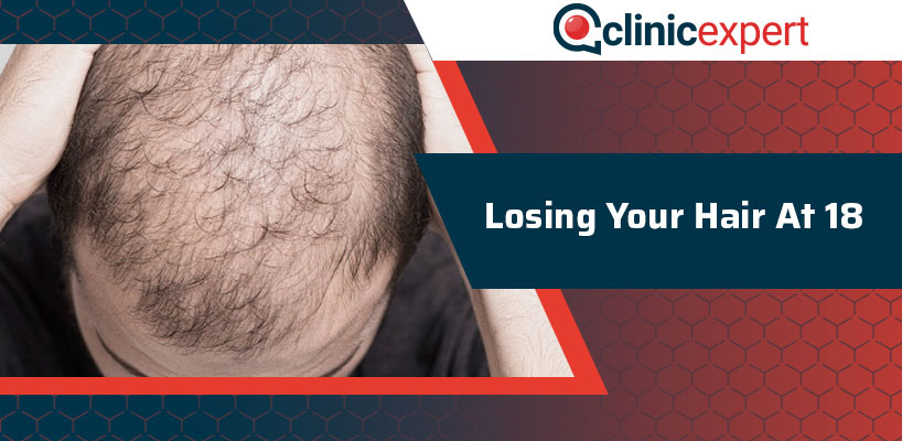 Losing Your Hair At 18