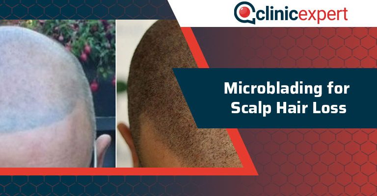 Microblading for Scalp Hair Loss