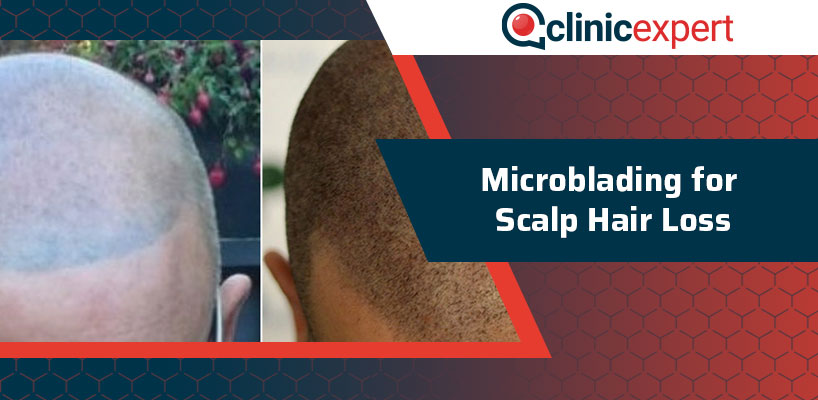 Microblading for Scalp Hair Loss