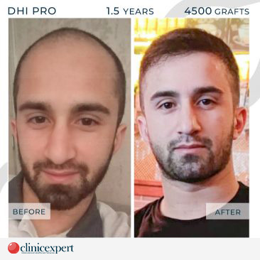 DHI Pro Hair Transplant-18 Months-4500Grafts