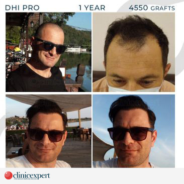 DHI Pro Hair Transplant-12 Months- 4550Grafts