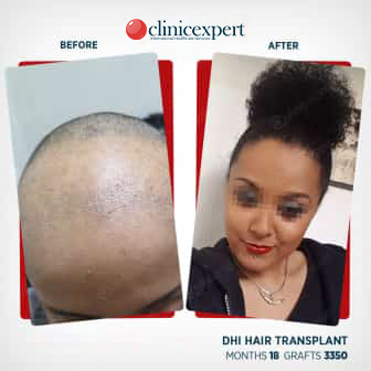 DHI Hair Transplant- 18 Months - 3350 Grafts