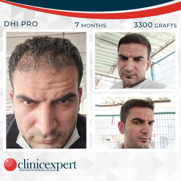 DHI Pro Hair Transplant-7 Months-3300Grafts