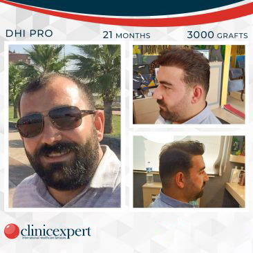 DHI Pro Hair Transplant- 21 Months- 3000 Grafts