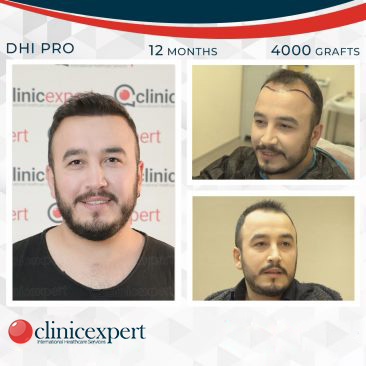 DHI Pro Hair Transplant- 12 Months- 4000 Grafts