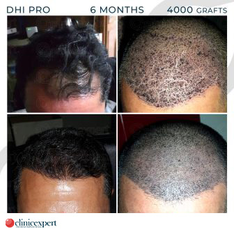 DHI Pro Hair Transplant - 6 Months - 4000 Grafts