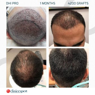 DHI Pro Hair Transplant- 1 Month - 4200 Grafts