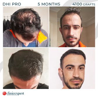 DHI Pro Hair Transplant- 5 Months -4100 Grafts