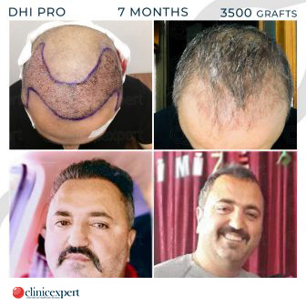 DHI Pro Hair Transplant - 7 Months - 3500 Grafts