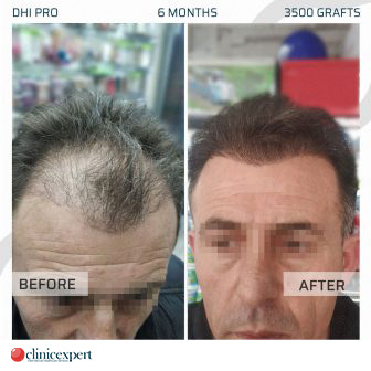 DHI Pro Hair Transplant - 6 Months - 4000 Grafts