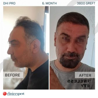 DHI Pro Hair Transplant - 6 Months - 3800 Grafts