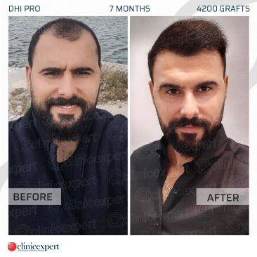 DHI Pro Hair Transplant - 7 Months - 4200 Grafts