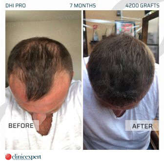 DHI Pro Hair Transplant - 7 Months - 4200 Grafts