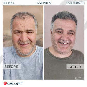 DHI Pro Hair Transplant - 6 Months - 3500 Grafts