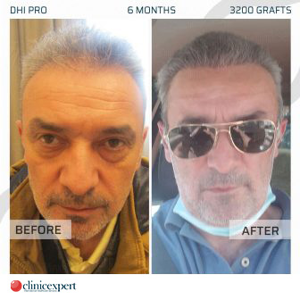 DHI Pro Hair Transplant - 6 Months - 3200 Grafts