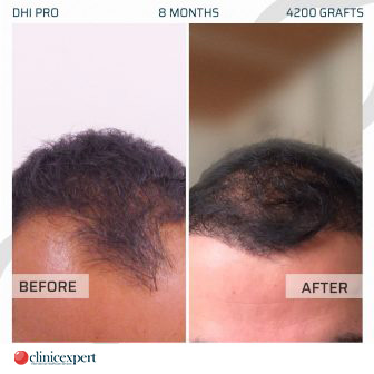 DHI Pro Hair Transplant - 8 Months - 4200 Grafts