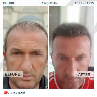 DHI Pro Hair Transplant - 7 Months - 4100 Grafts