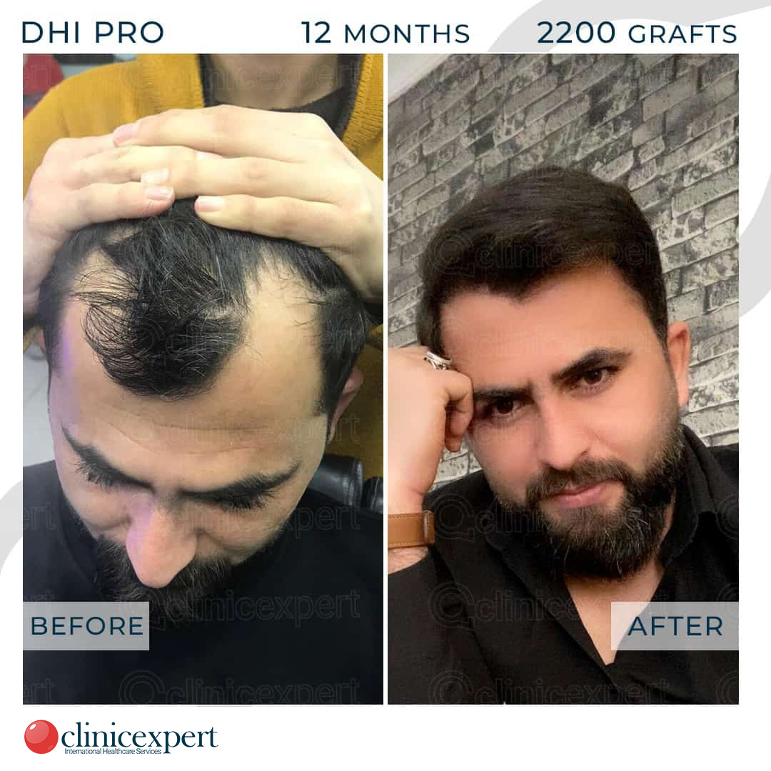 DHI Pro Hair Transplant - 12 Months - 2200 Grafts