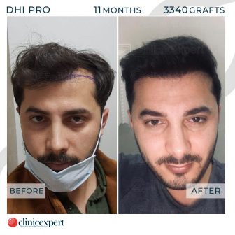 DHI Pro Hair Transplant- 11 Months - 3340 Grafts