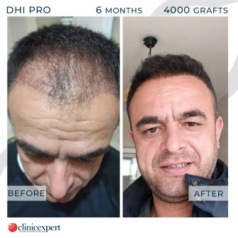 DHI Pro Hair Transplant- 6 Months - 4000 Grafts