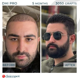 DHI Pro Hair Transplant- 5 Months - 3050 Grafts