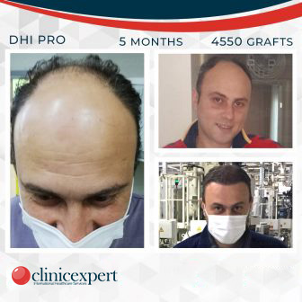 DHI Pro Hair Transplant- 5 Months 4550 Grafts