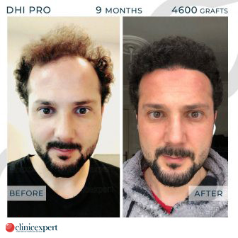 DHI Pro Hair Transplant- 9 Months - 4600 Grafts