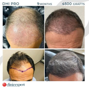 DHI Pro Hair Transplant- 9 Months - 4500Grafts