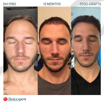 DHI Pro Hair Transplant- 12 Months - 2500 Grafts