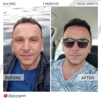 DHI Pro - Hair Transplant - 7 Months - 3450 Grafts