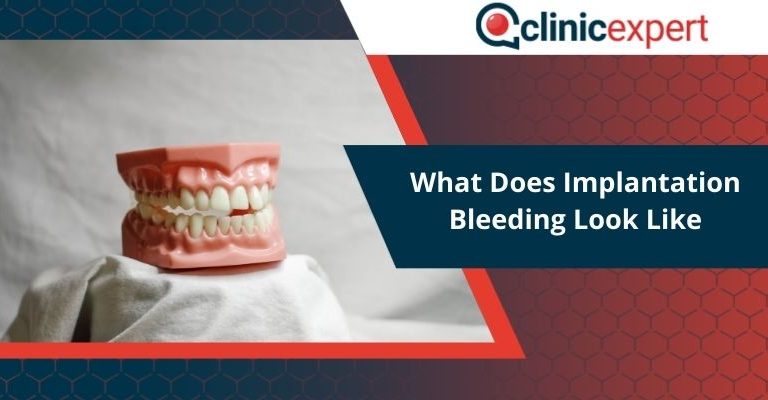 What Does Implantation Bleeding Look Like