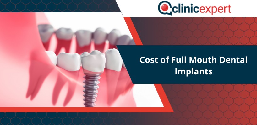 Cost of Full Mouth Dental Implants