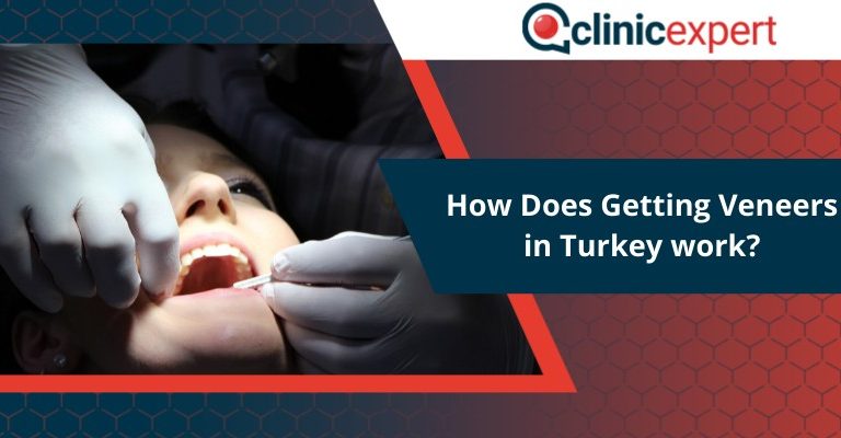 How Does Getting Veneers in Turkey work?