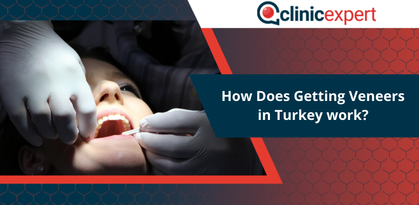 How Does Getting Veneers in Turkey work?
