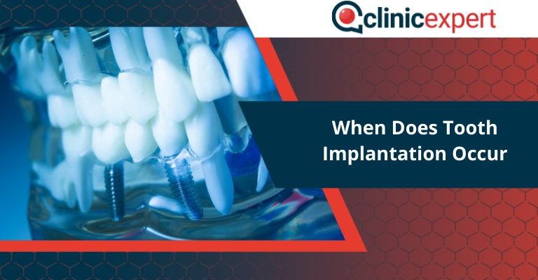 When Does Tooth Implantation Occur