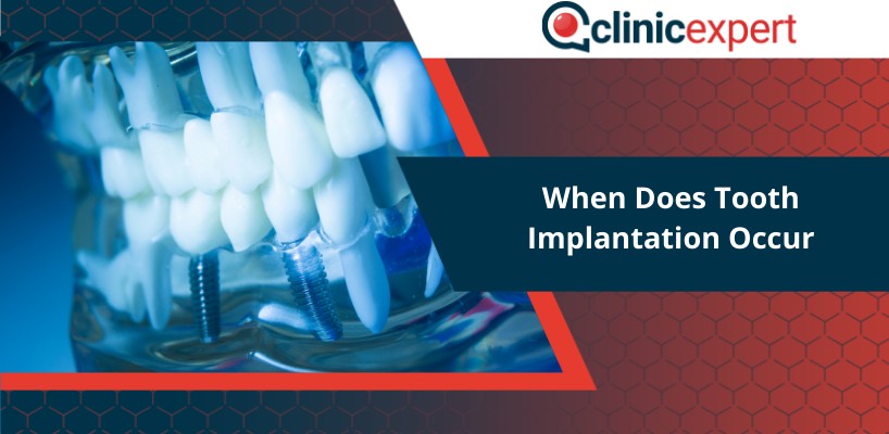 When Does Tooth Implantation Occur