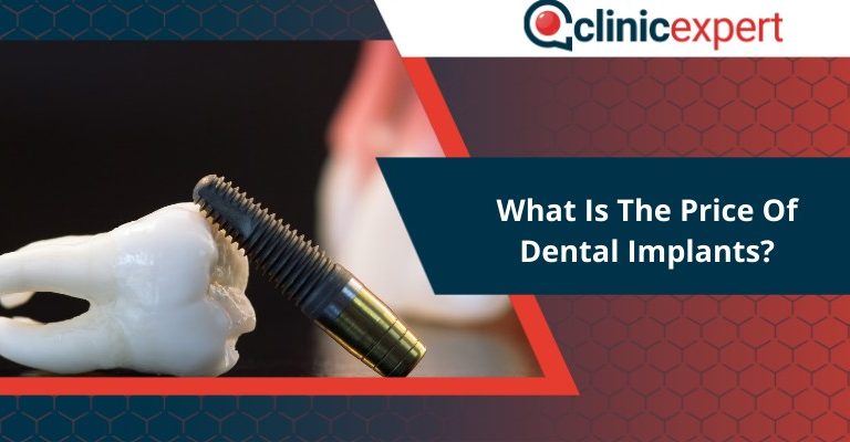 What is the price of Dental Implants?