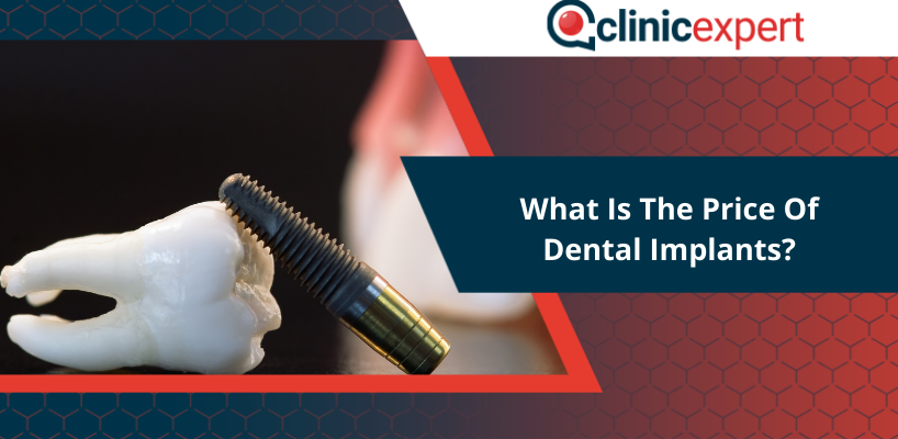 What is the price of Dental Implants?