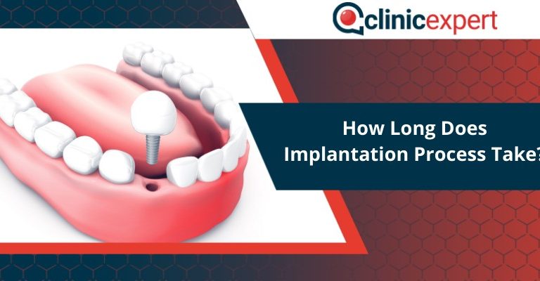 How Long Does Implantation Process Take?