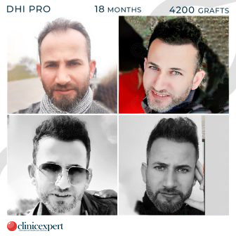 DHI Pro - Hair Transplant - 18 Months - 4200Grafts